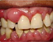 periodoncia1